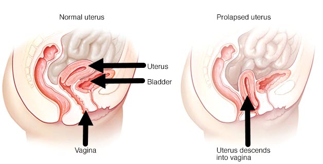 Prolapsed uterus - symptoms and treatment