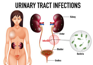 Incomplete Bladder Emptying: Causes and Treatments - Peter M. Lotze, MD ...